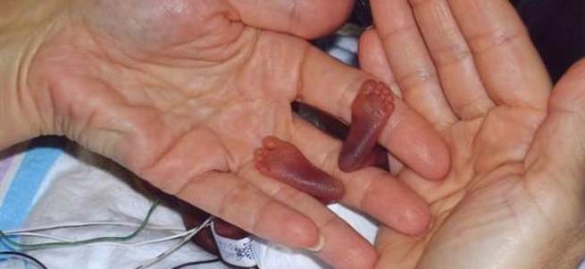 284 gram doğmuştu, şimdi ne halde?