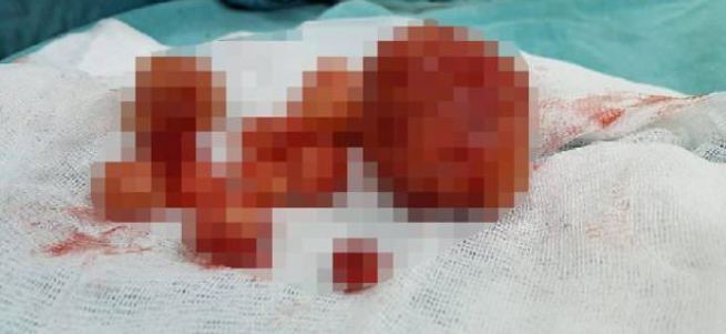 'Çocuğum olmuyor' diye gitti, rahminden 1 kilo ur çıktı